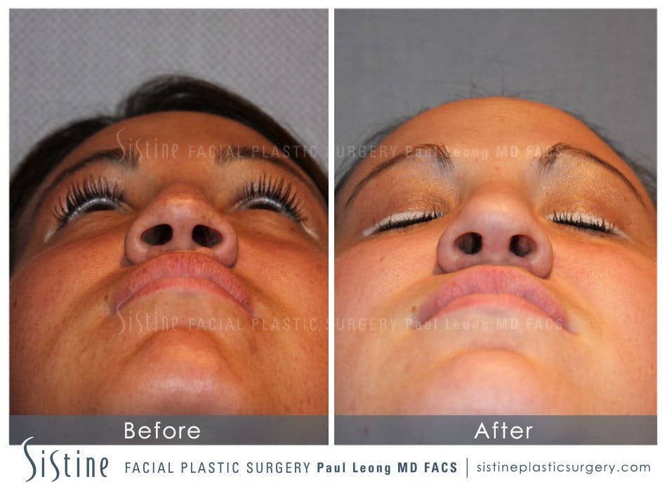 Rhinoplasty Before and After | Leong Facial Plastic Surgery
