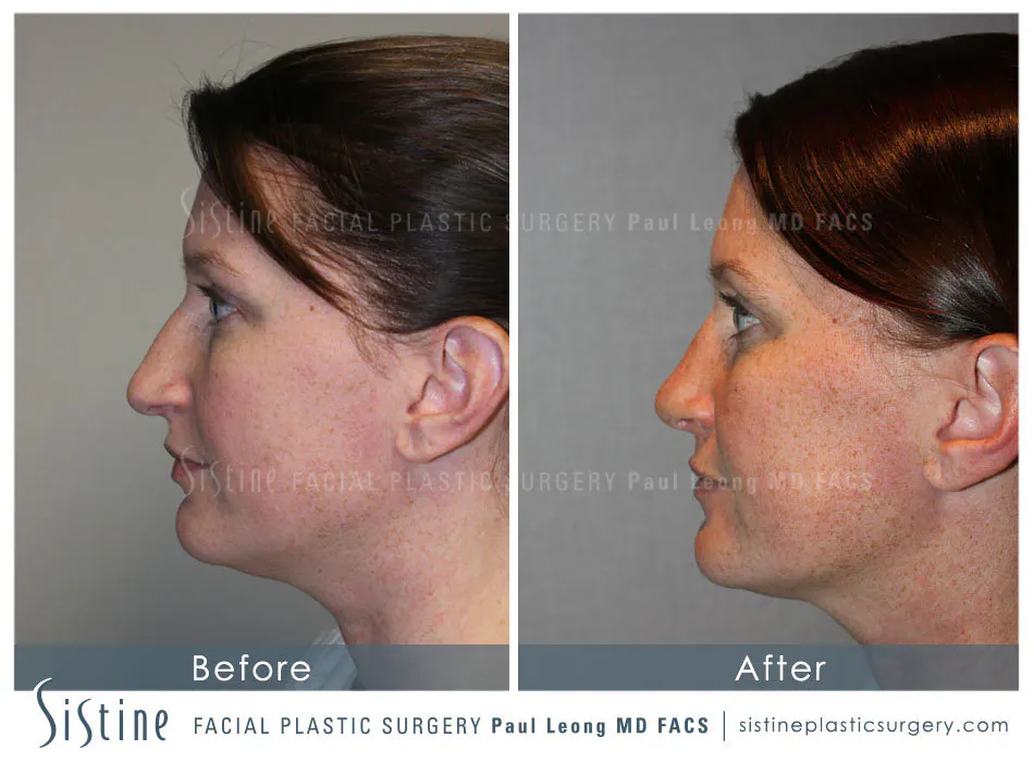 Upturned Nose Tip After Rhinoplasty - Preoperative Right Lateral View | Dr. Paul Leong