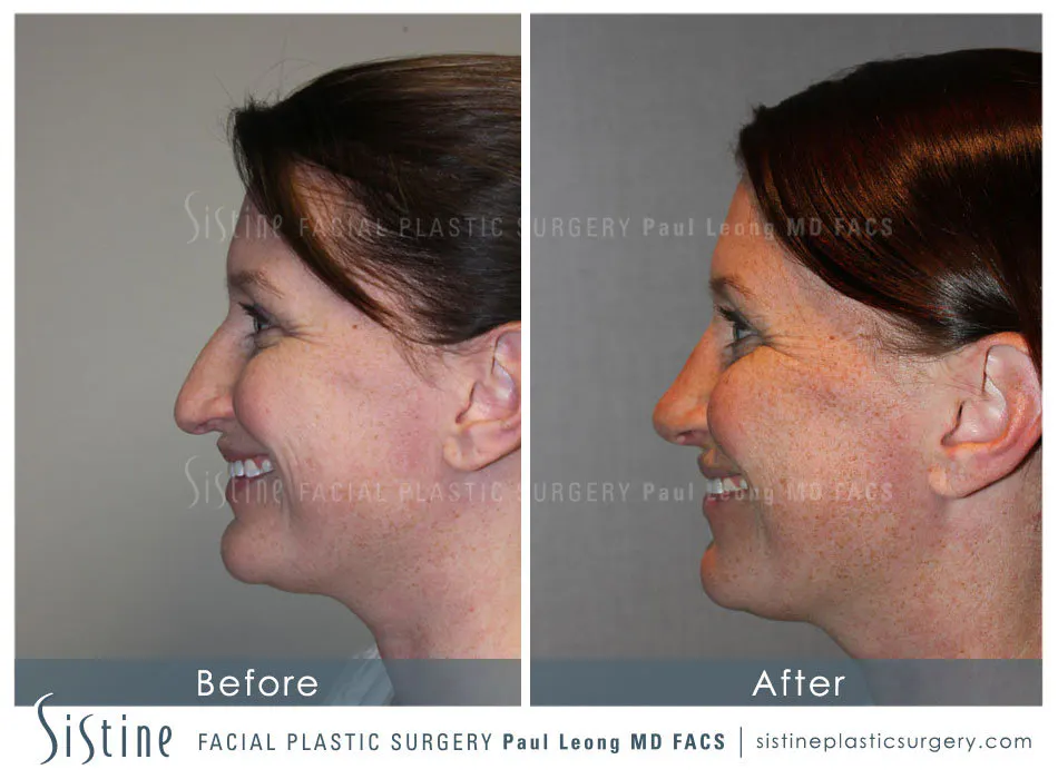 Drooping Nasal Tip Correction - Preoperative Right Lateral Smiling View | Dr. Leong, Pittsburgh 