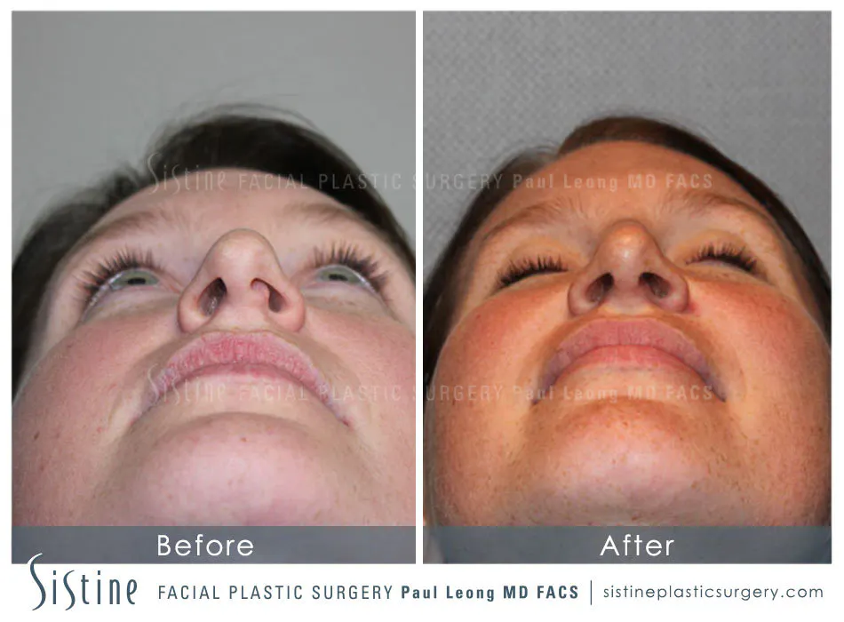 Nasal Septum Correction - Preoperative Basal View | Dr. Paul Leong