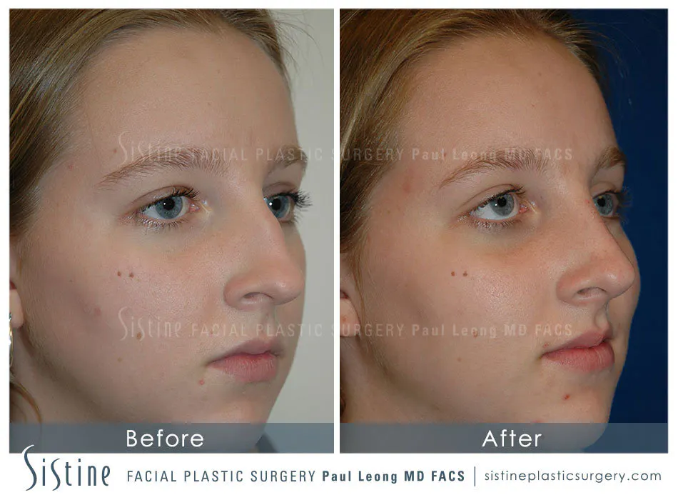 Rhinoplasty Before and After | Leong Facial Plastic Surgery