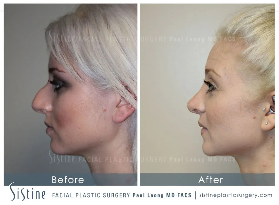 Septal Repair Nose Job - Right Lateral Preoperative View | Paul Leong MD