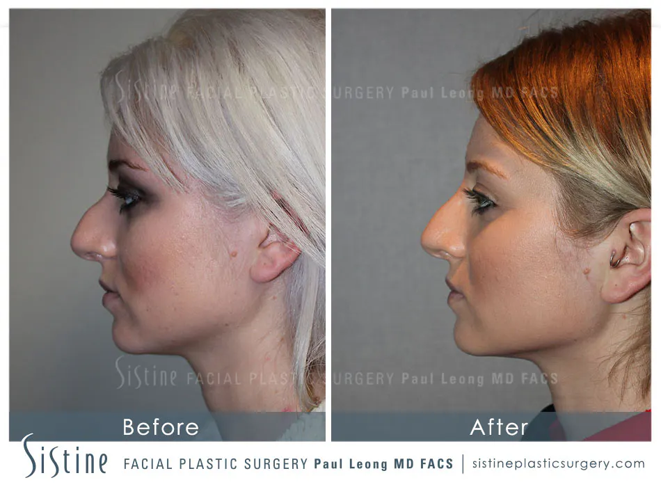 Septum Repair Nose Job - Preoperative Basal View | Dr. Paul Leong