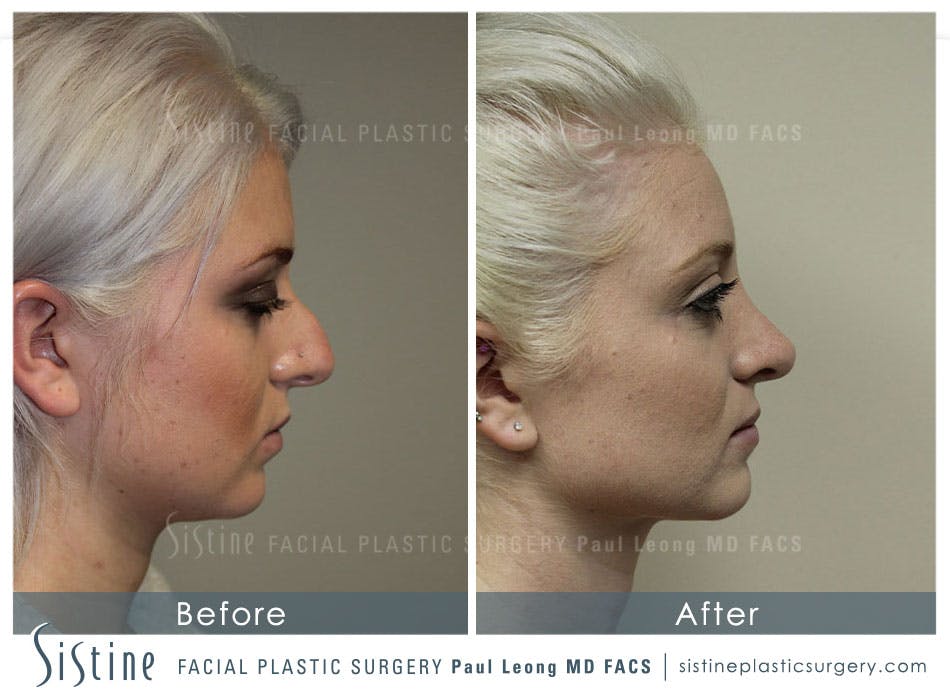 Rhinoplasty Before and After | Leong Facial Plastic Surgery