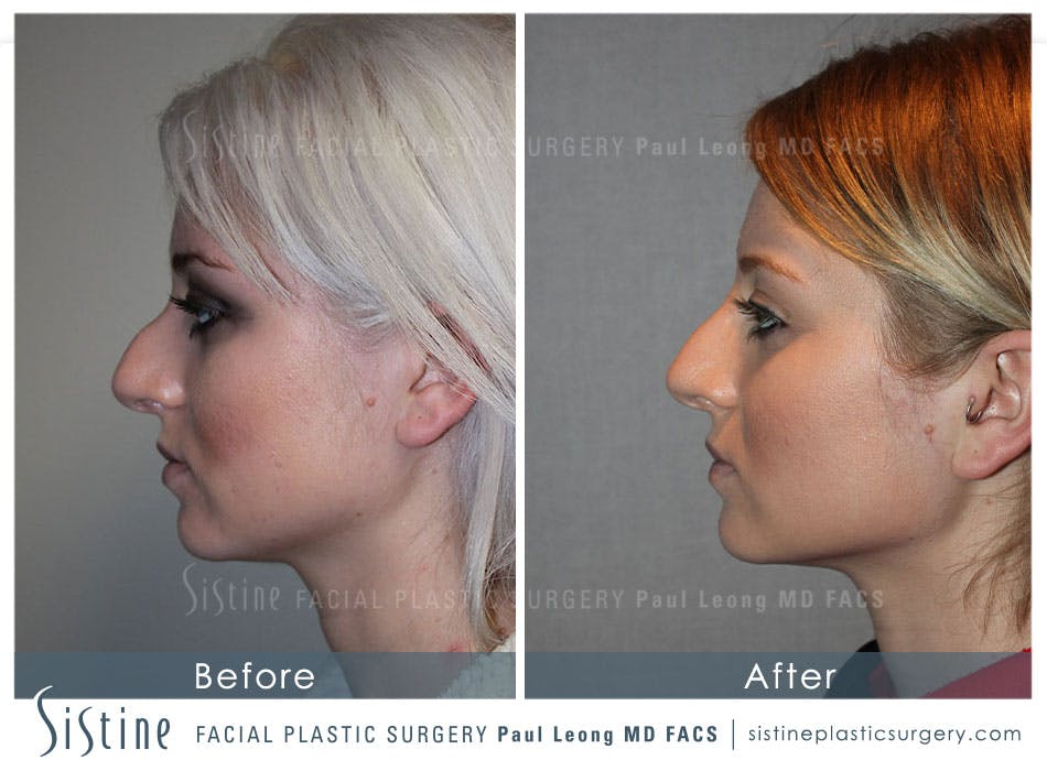 Rhinoplasty Before and After | Leong Facial Plastic Surgery