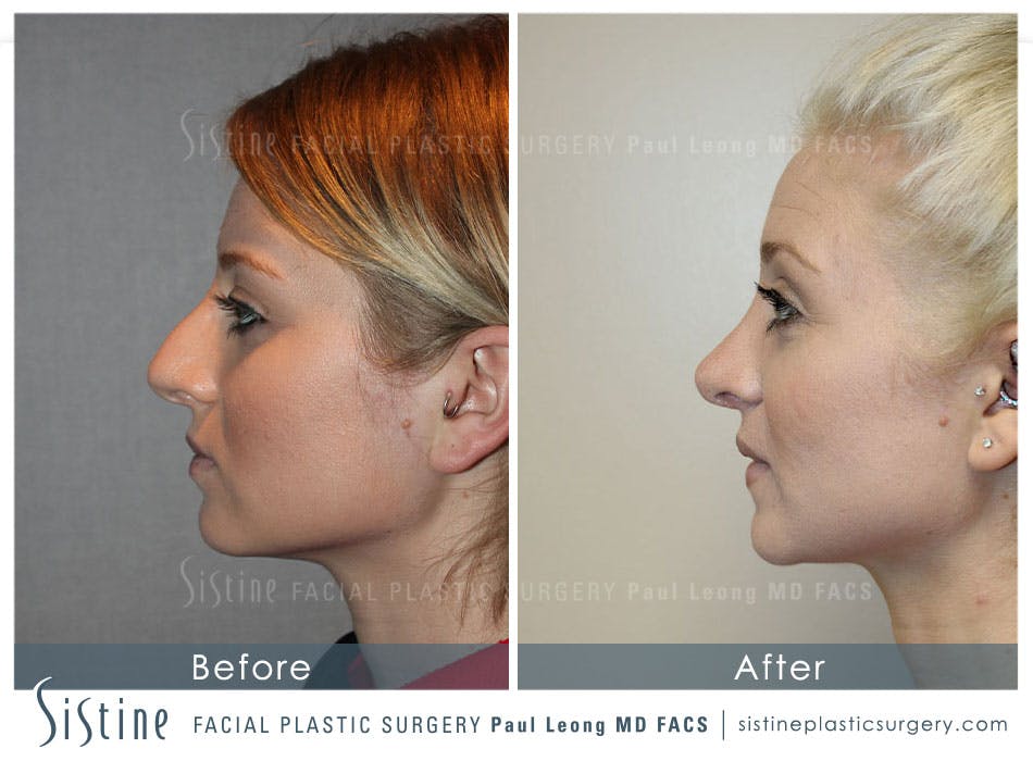 Rhinoplasty Before and After | Leong Facial Plastic Surgery