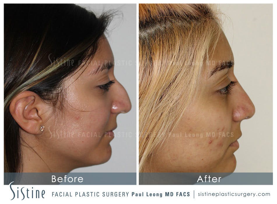 Rhinoplasty Before and After | Leong Facial Plastic Surgery