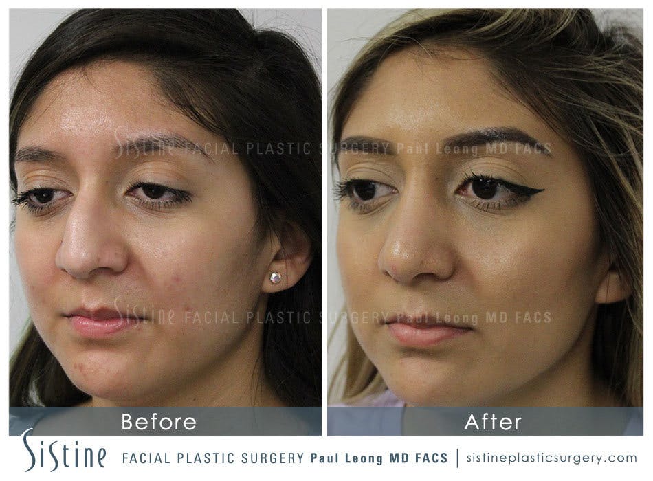 Rhinoplasty Before and After | Leong Facial Plastic Surgery