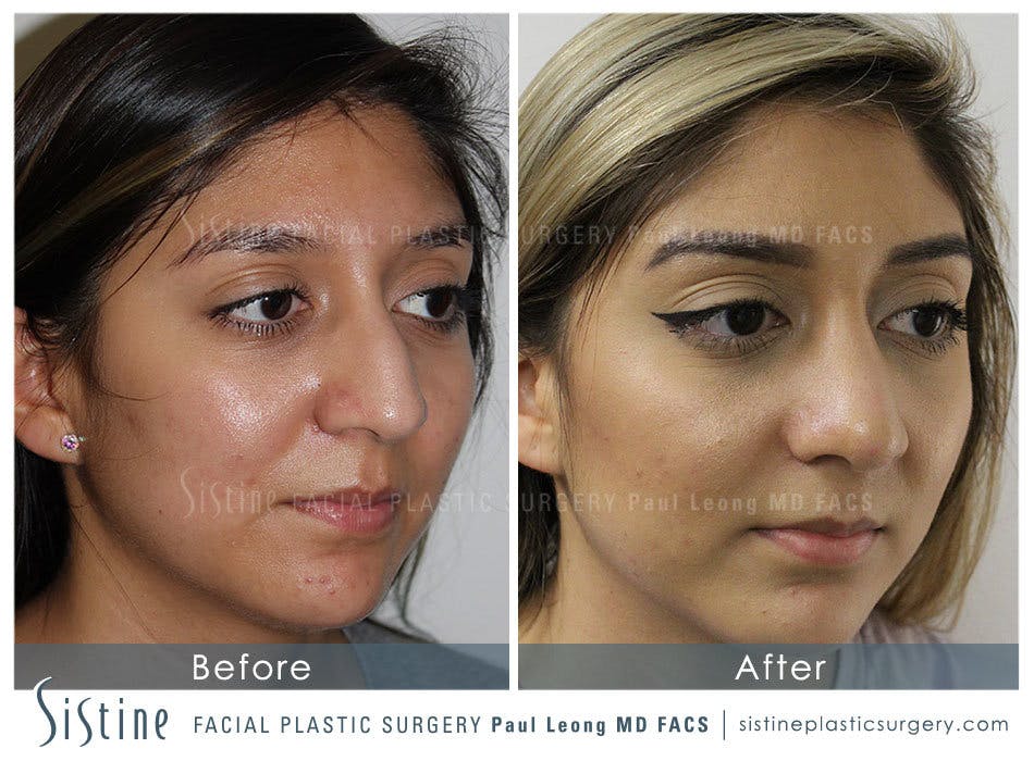 Rhinoplasty Before and After | Leong Facial Plastic Surgery
