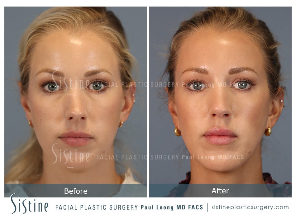 Rhinoplasty Before and After | Leong Facial Plastic Surgery