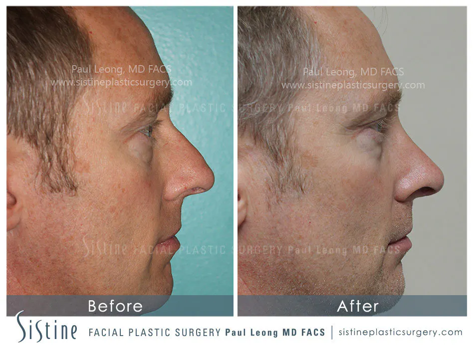 Rhinoplasty Before and After | Leong Facial Plastic Surgery