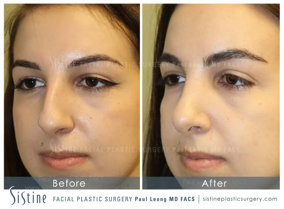 Highland Park Pittsburgh Cosmetic Rhinoplasty - Preoperative Patient Image | Paul Leong MD