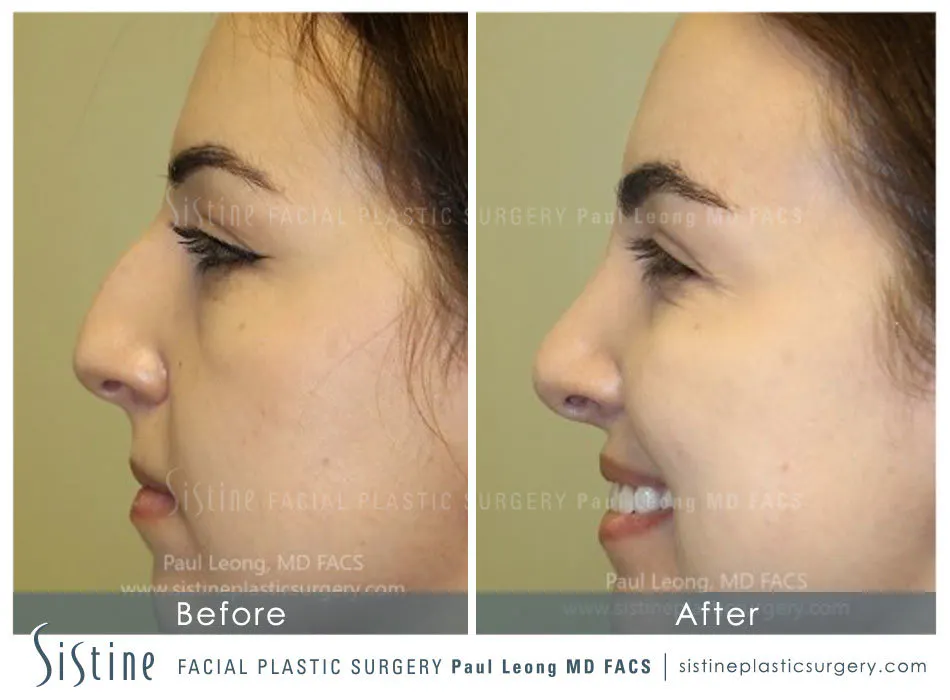 Rhinoplasty Before and After | Leong Facial Plastic Surgery