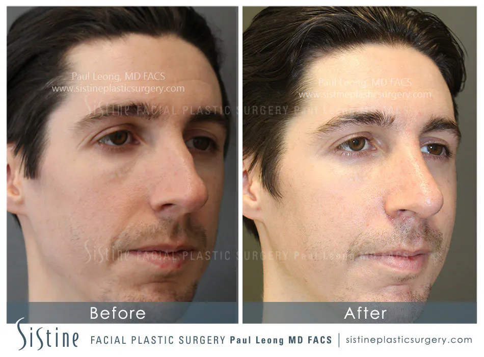 Rhinoplasty Before and After | Leong Facial Plastic Surgery