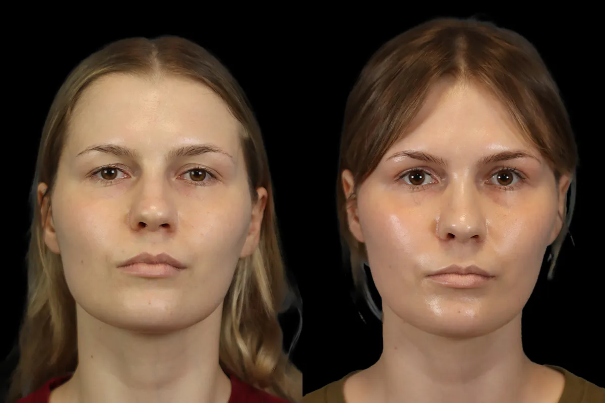 Rhinoplasty Before and After | Leong Facial Plastic Surgery