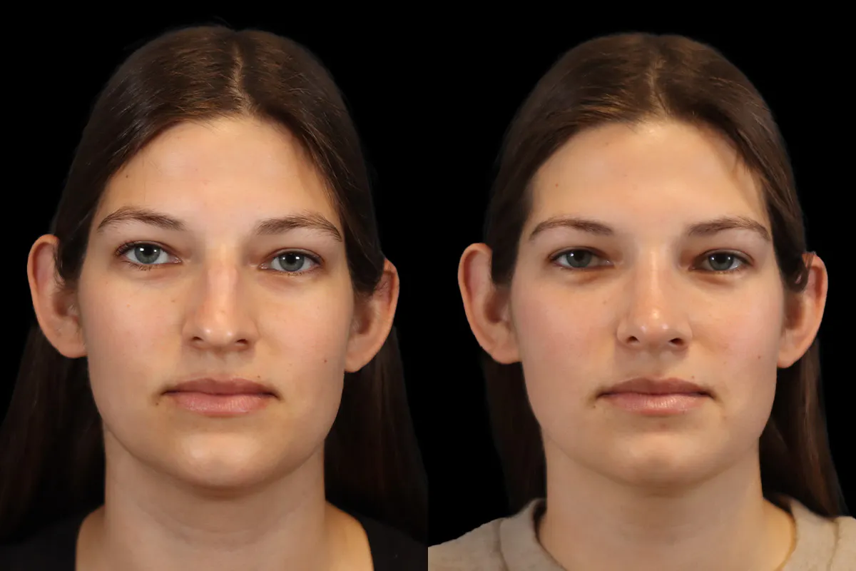 Rhinoplasty Before and After | Leong Facial Plastic Surgery