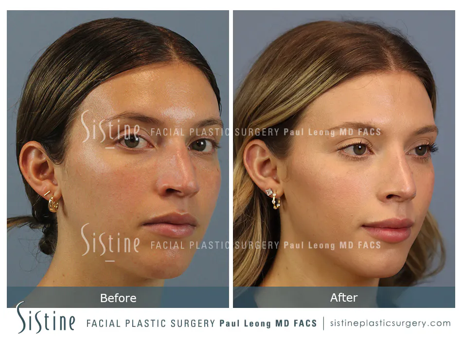 Rhinoplasty Before and After | Leong Facial Plastic Surgery
