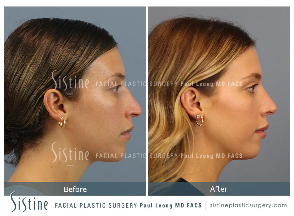 Rhinoplasty Before and After | Leong Facial Plastic Surgery