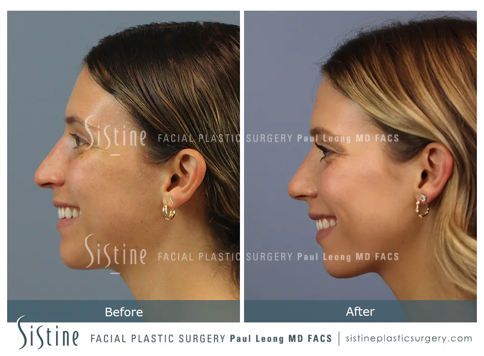 Rhinoplasty Before and After | Leong Facial Plastic Surgery