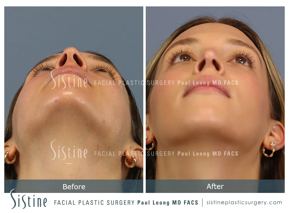 Rhinoplasty Before and After | Leong Facial Plastic Surgery
