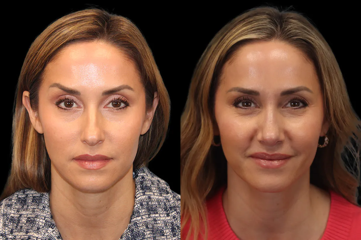 Rhinoplasty Before and After | Leong Facial Plastic Surgery