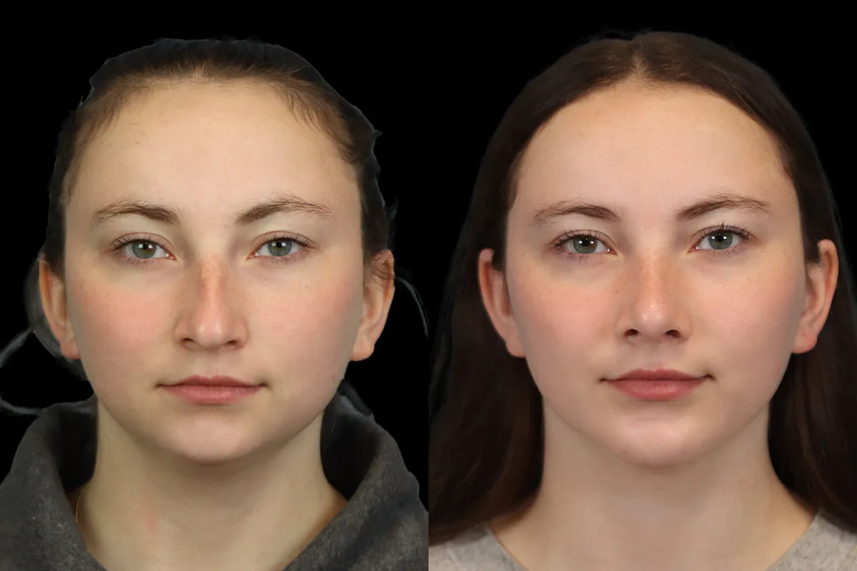 Rhinoplasty Before and After | Leong Facial Plastic Surgery