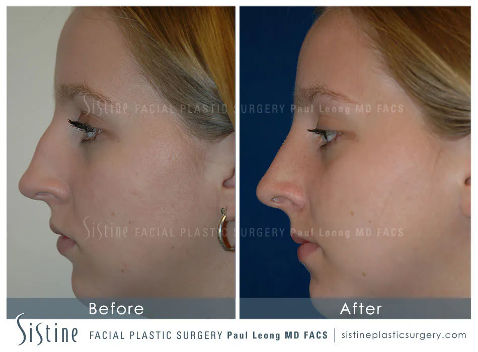 Rhinoplasty Before and After | Leong Facial Plastic Surgery