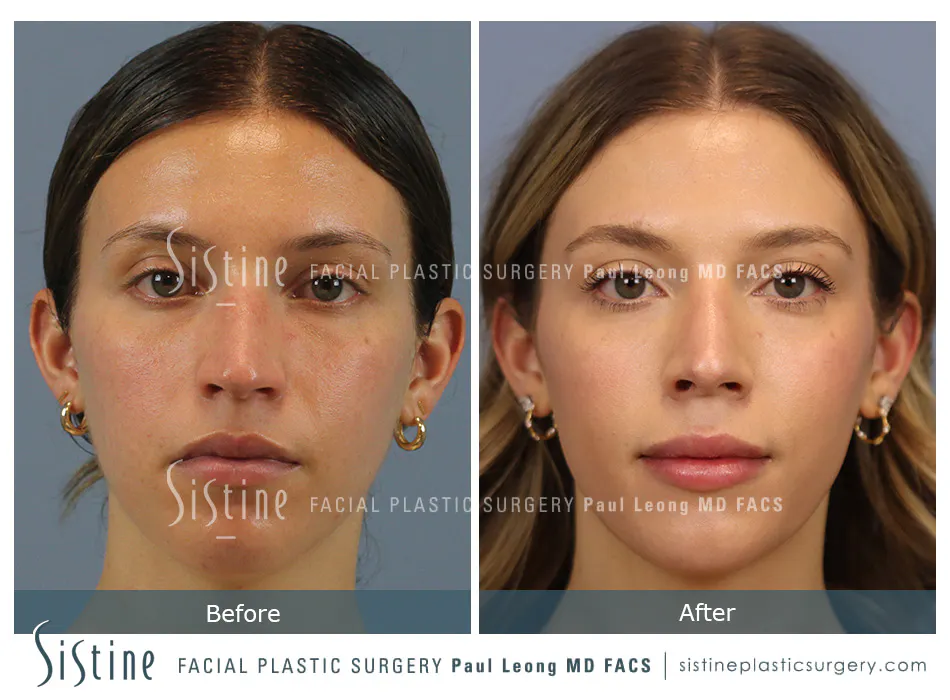 Rhinoplasty for Breathing - Preoperative View | Dr. Paul Leong