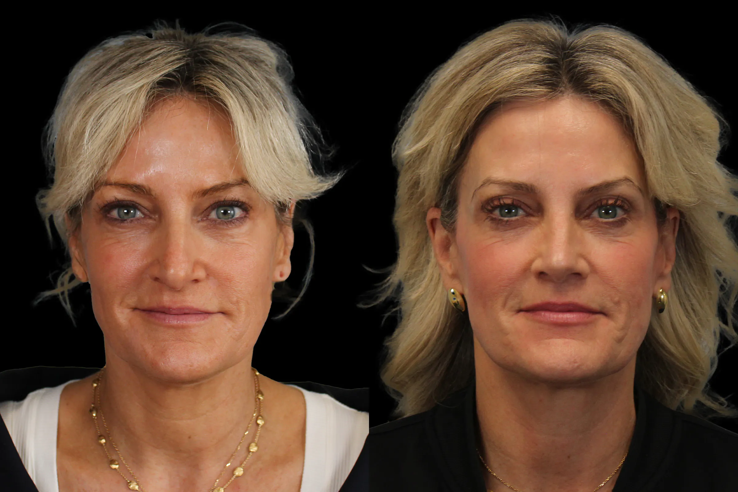 Rhinoplasty Before and After | Leong Facial Plastic Surgery