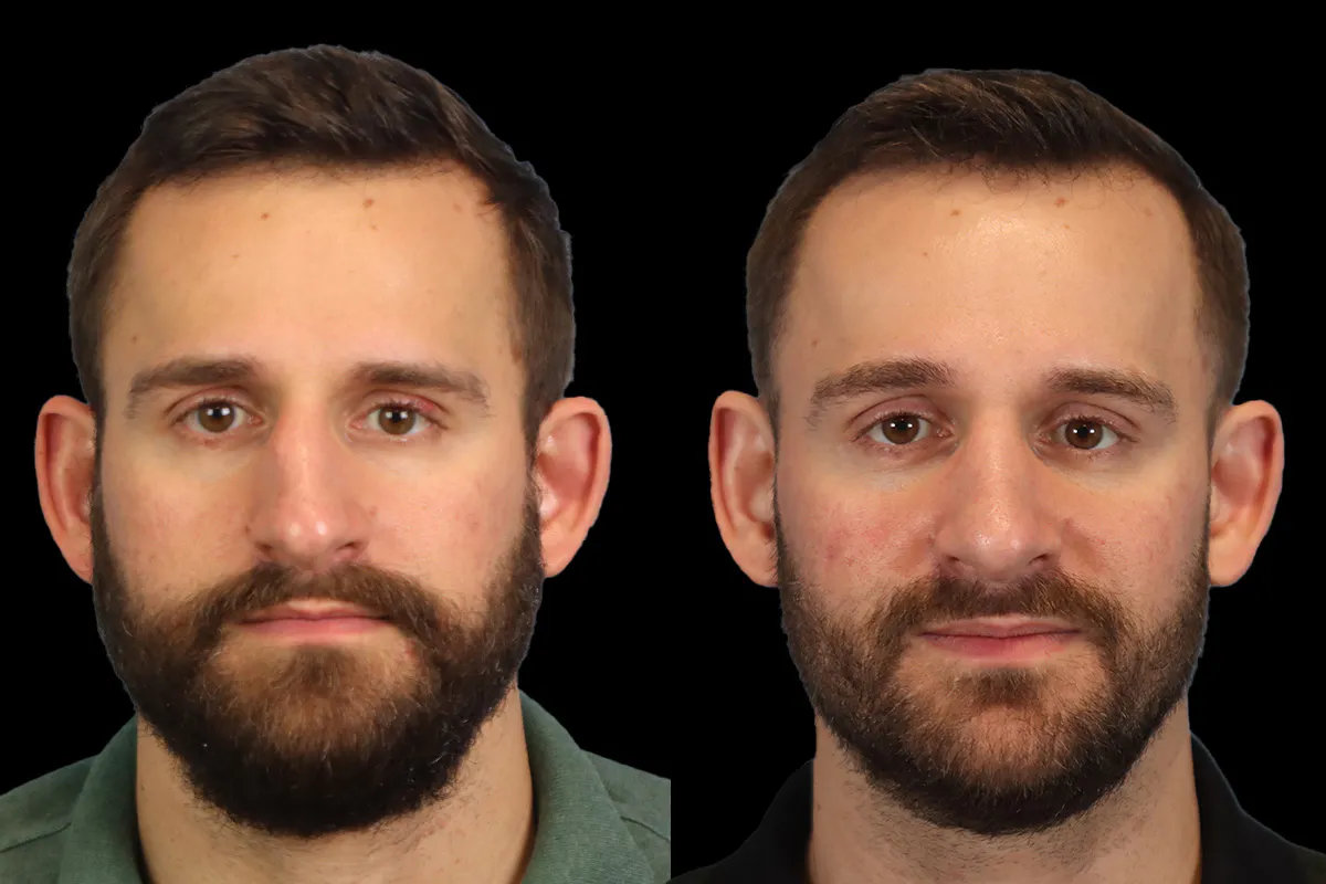 Rhinoplasty Before and After | Leong Facial Plastic Surgery
