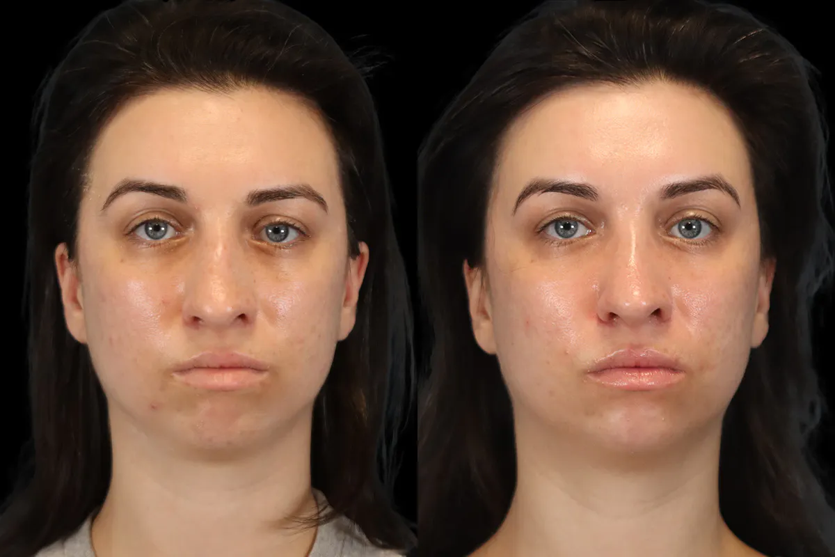 Rhinoplasty Before and After | Leong Facial Plastic Surgery