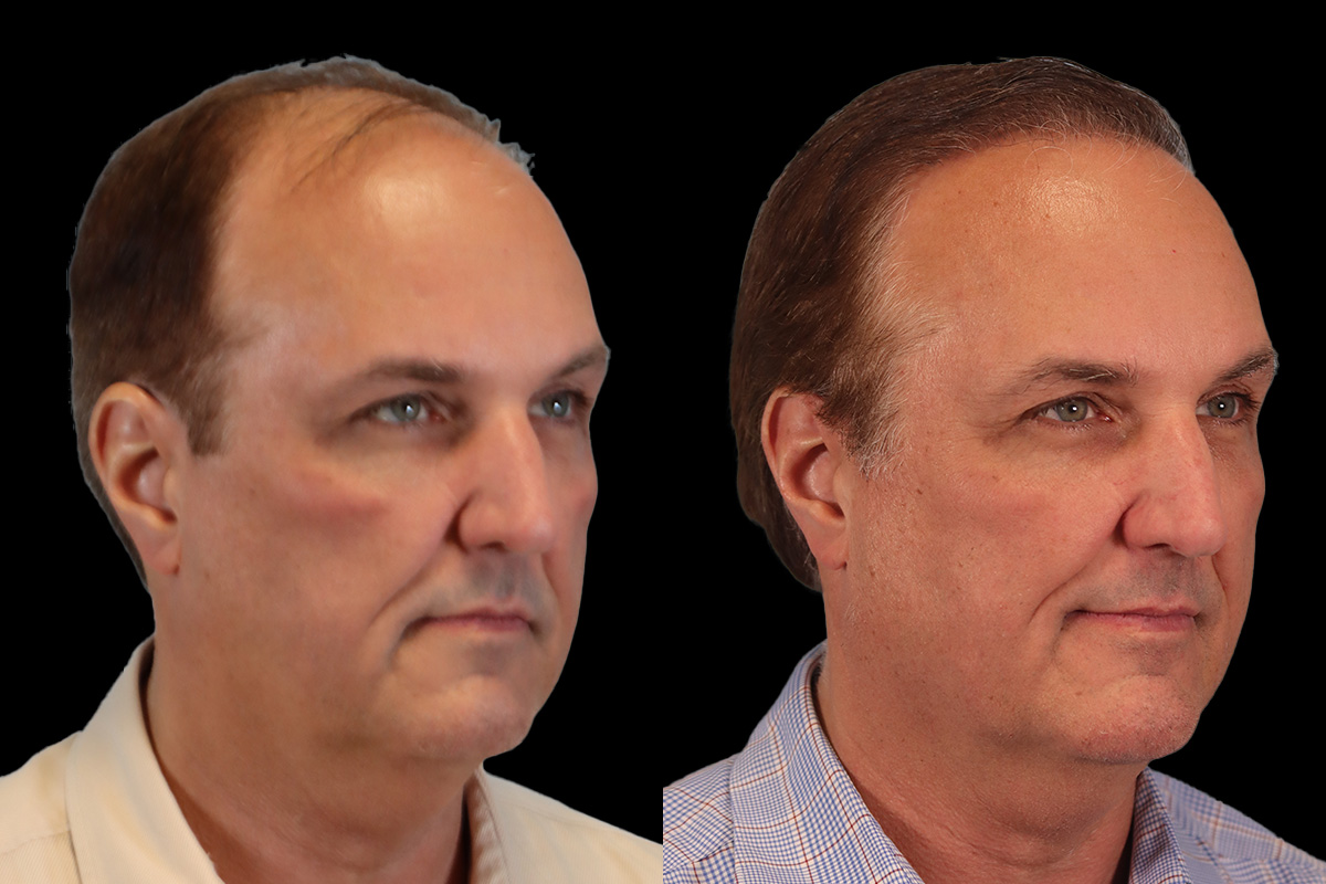 Hair Transplant Before and After | Leong Facial Plastic Surgery