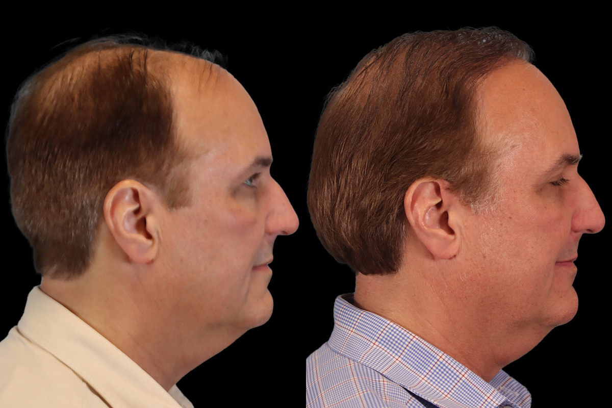 Hair Transplant Before and After | Leong Facial Plastic Surgery