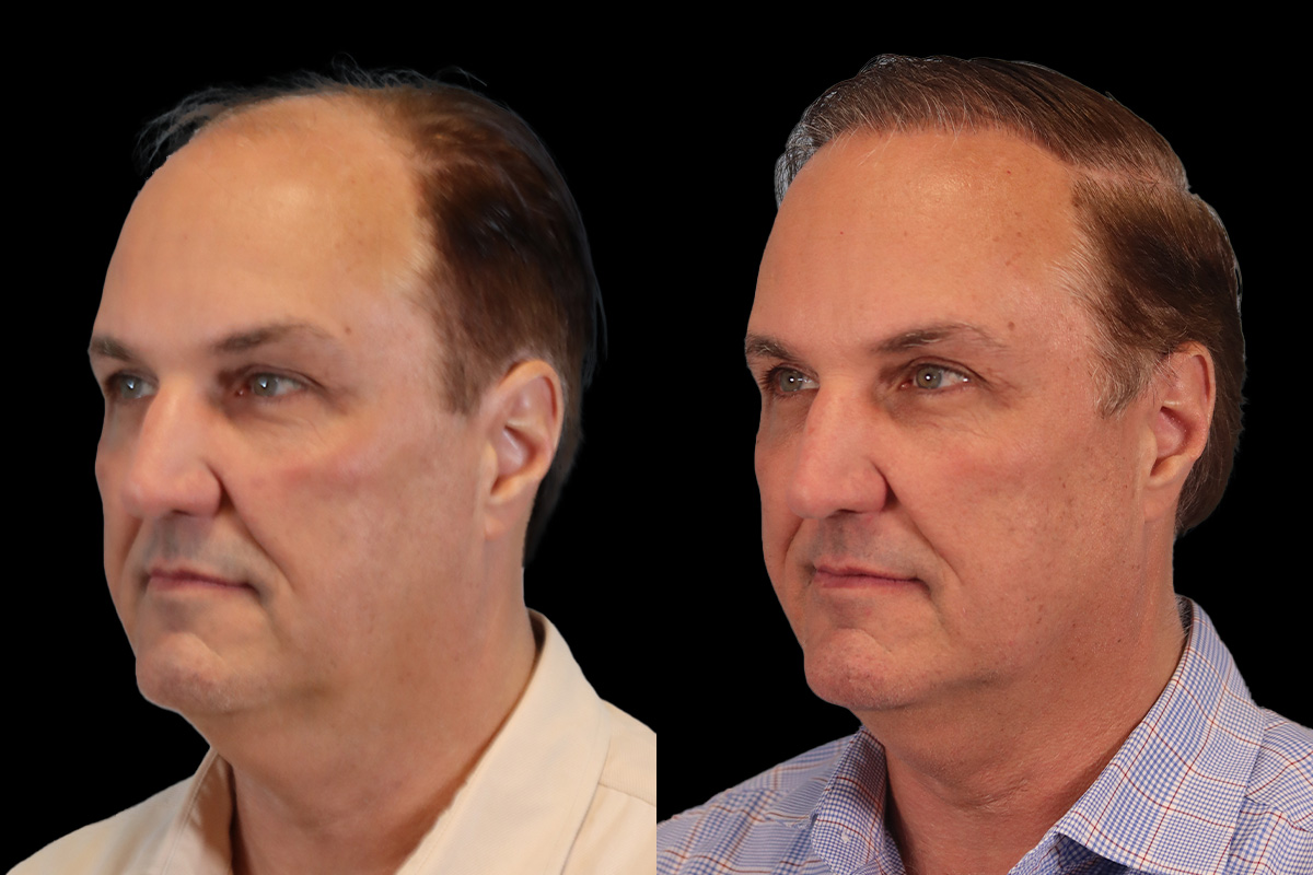 Hair Transplant Before and After | Leong Facial Plastic Surgery