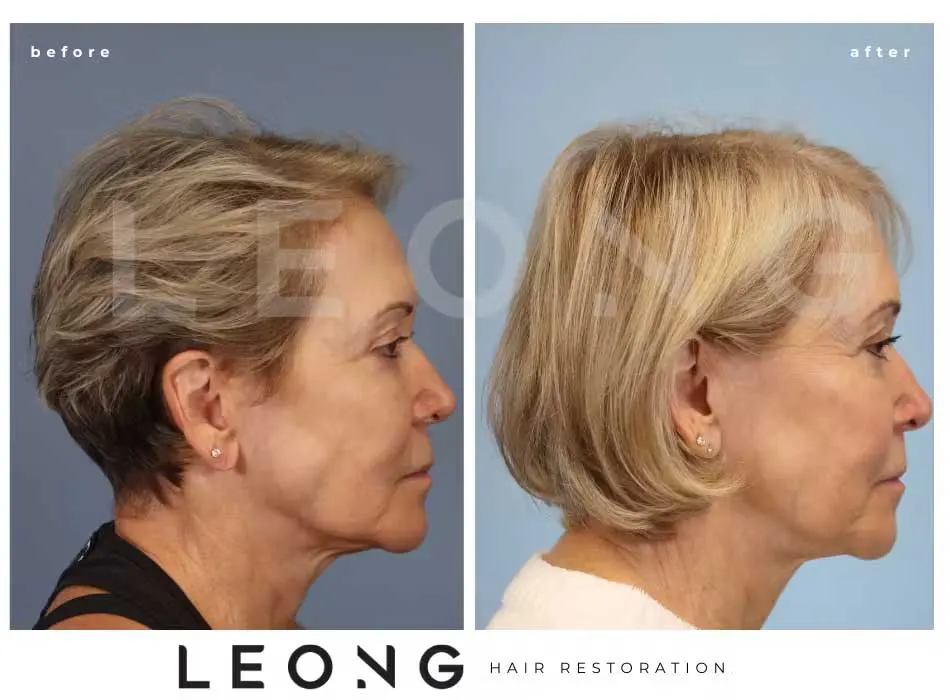 Hair Transplant Before and After | Leong Facial Plastic Surgery