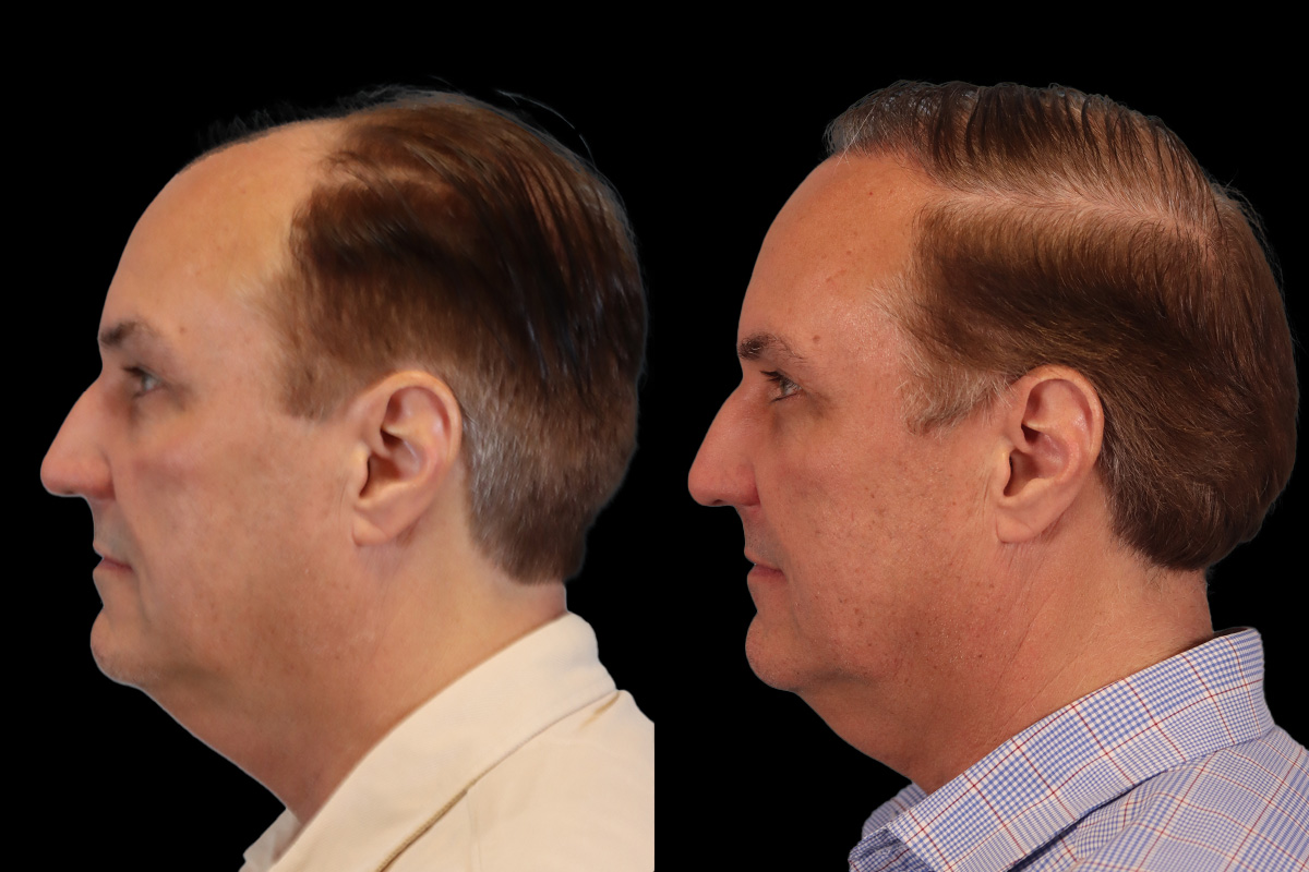 Hair Transplant Before and After | Leong Facial Plastic Surgery