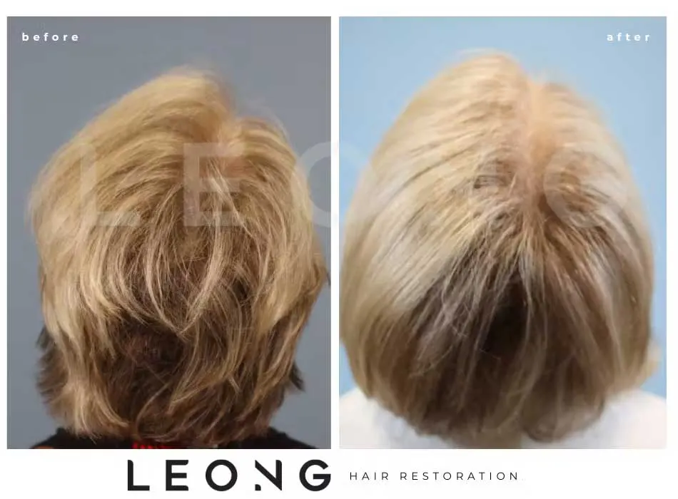 Hair Transplant Before and After | Leong Facial Plastic Surgery