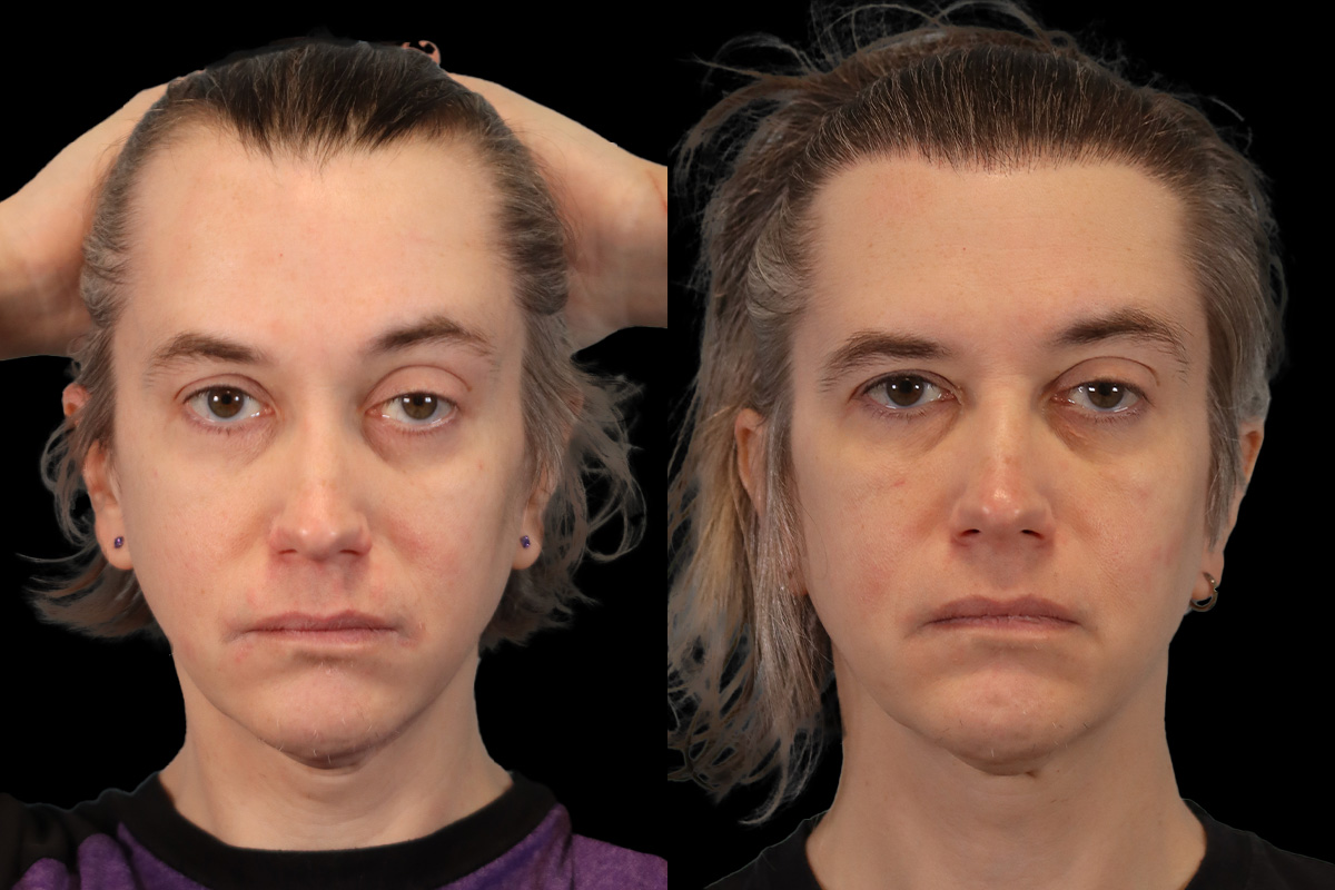 Hair Transplant Before and After | Leong Facial Plastic Surgery