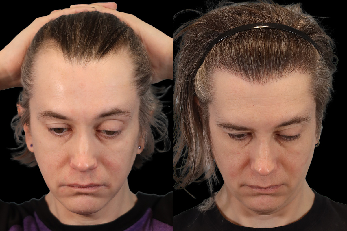 Hair Transplant Before and After | Leong Facial Plastic Surgery