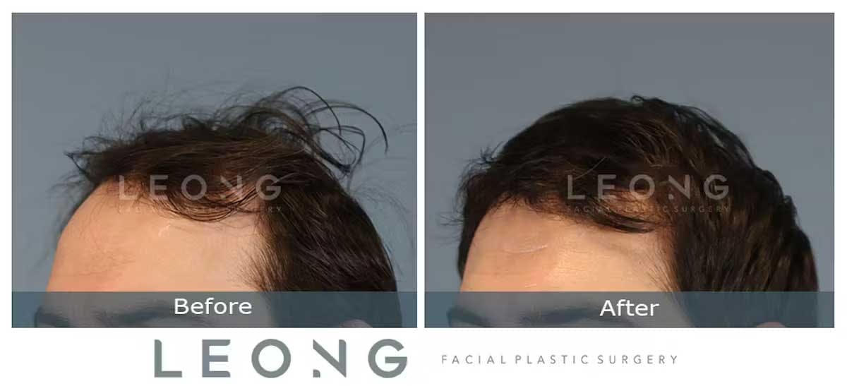 Hair Transplant Before and After | Leong Facial Plastic Surgery