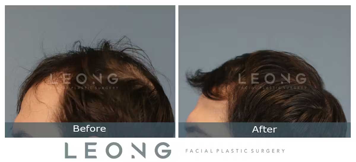 Hair Transplant Before and After | Leong Facial Plastic Surgery