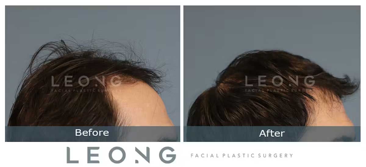 Hair Transplant Before and After | Leong Facial Plastic Surgery