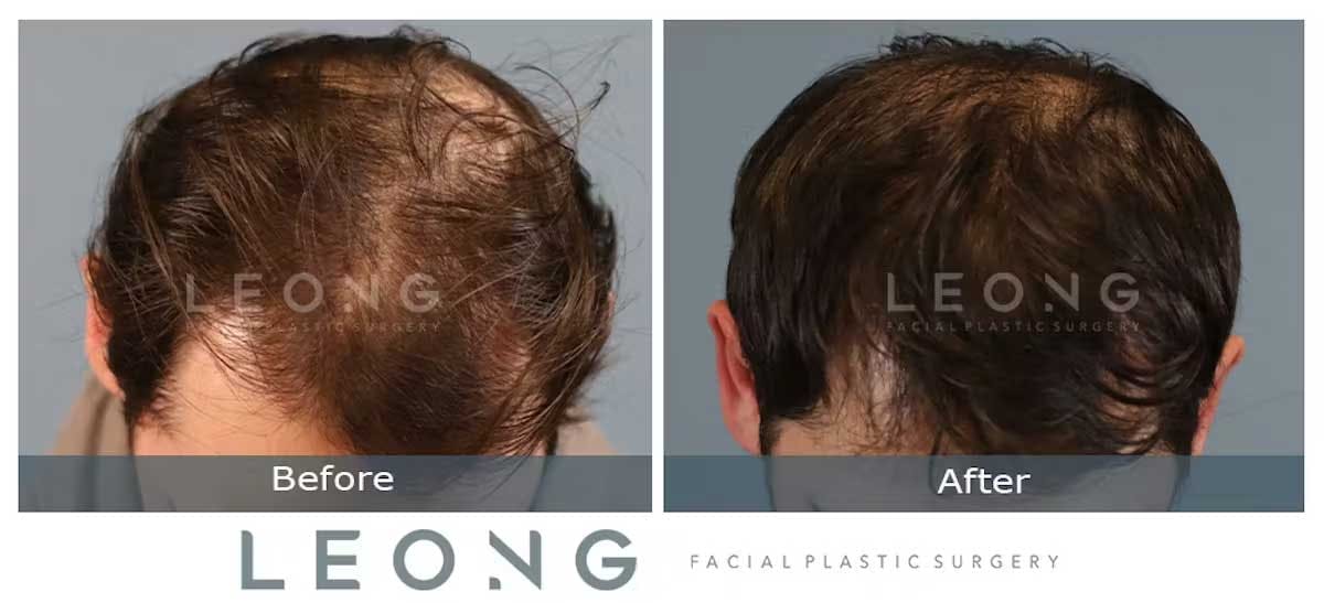 Hair Transplant Before and After | Leong Facial Plastic Surgery