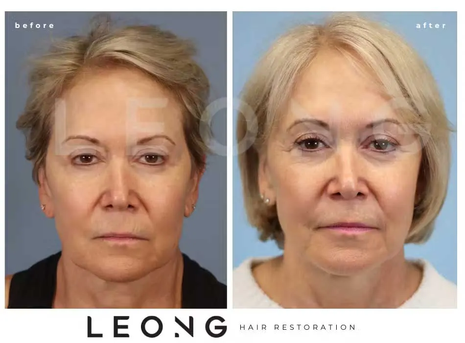 Hair Transplant Before and After | Leong Facial Plastic Surgery