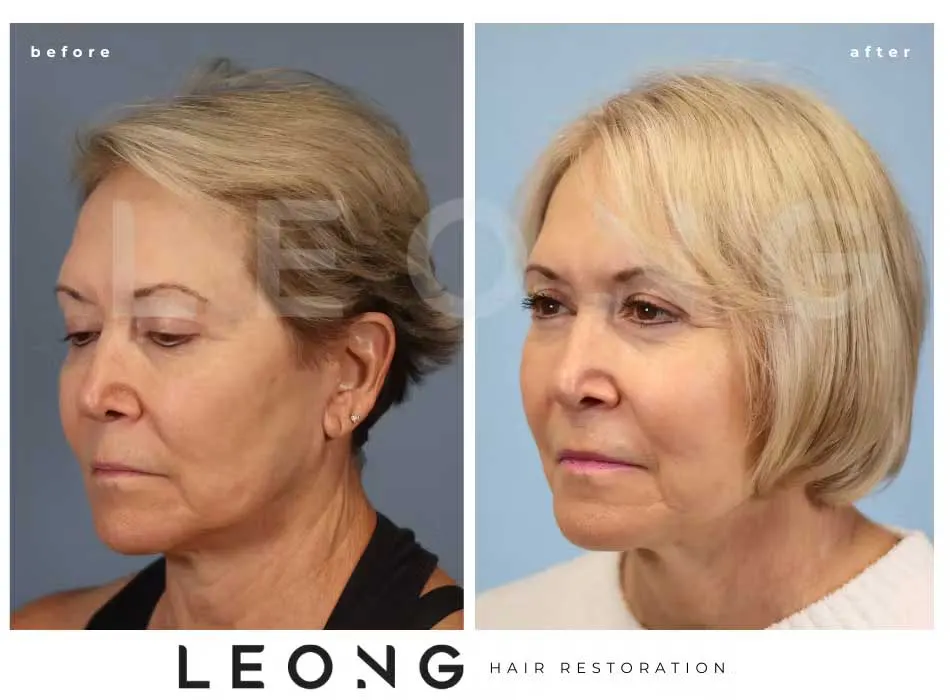 Hair Transplant Before and After | Leong Facial Plastic Surgery