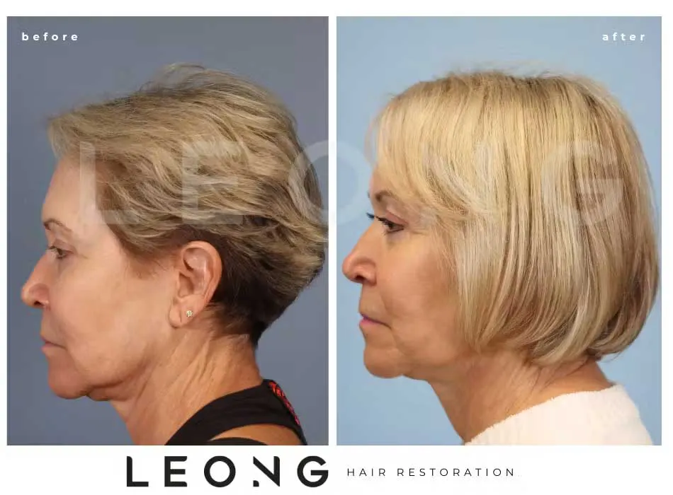 Hair Transplant Before and After | Leong Facial Plastic Surgery