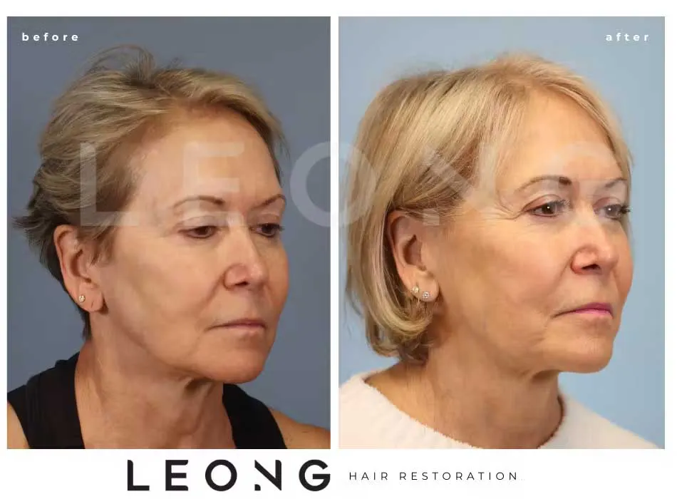 Hair Transplant Before and After | Leong Facial Plastic Surgery