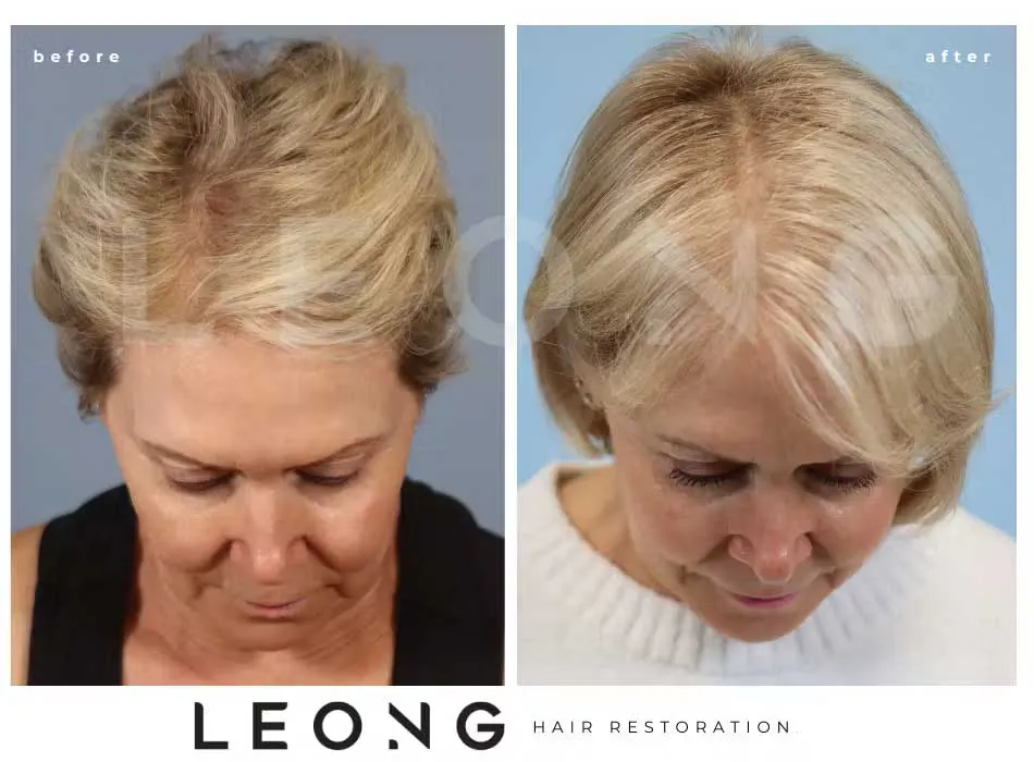 Hair Transplant Before and After | Leong Facial Plastic Surgery
