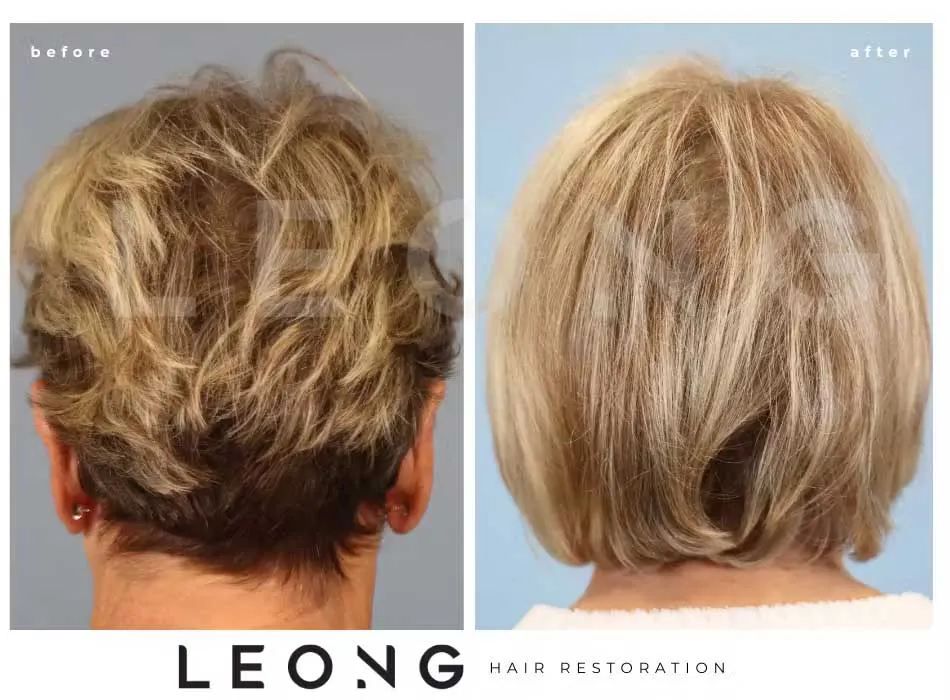 Hair Transplant Before and After | Leong Facial Plastic Surgery
