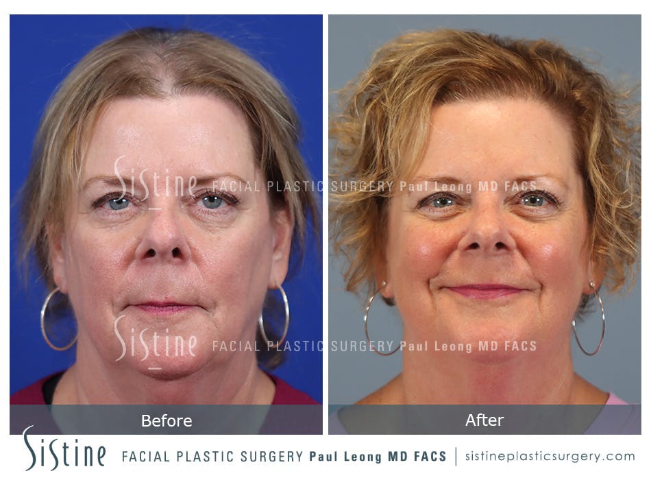 Hair Transplant Before and After | Leong Facial Plastic Surgery